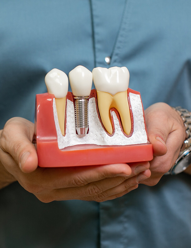 Implanty zębów Piaseczno implanty zębów piaseczno