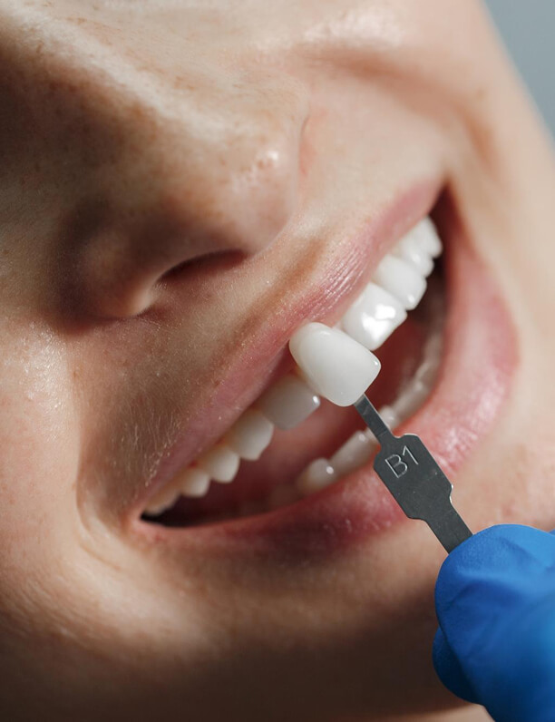 Licówki Piaseczno licówki piaseczno