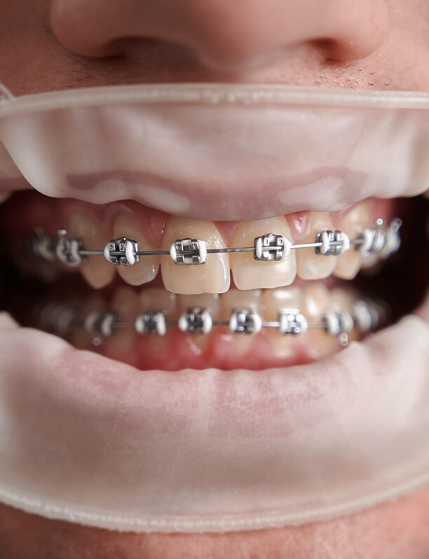 Ortodoncja Piaseczno ortodoncja piaseczno